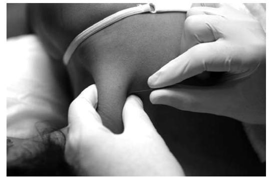 Obrázek 12. Terapie suchou jehlou na MTrP v musculus trapezius (19), převzato. 3.