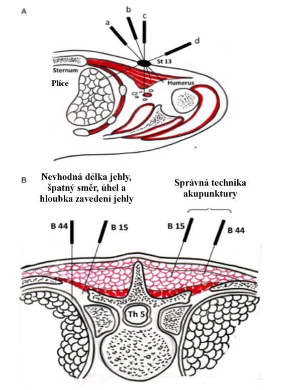 kterých byl nalezen latentní MTrP v m. trapezius.