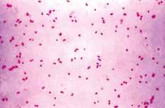 Gonorrhoea kapavka Jedná se o akutní hnisavý zánět, který postihuje primárně sliznice urogenitálního traktu. Může způsobit také zánět oční spojivky, rekta a vzácně i sliznice nosu, úst a laryngu.