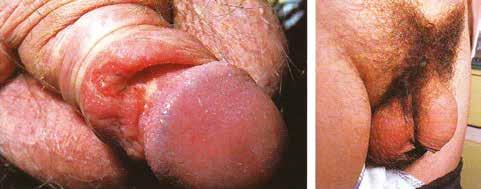 Siphilis primaria ulcus durum penisu s ingvinální lymfadenopatií (Dermatovenerologie, Jiří Štork et al.) dní), další alternativou jsou fluorochinolony, klindamycin.