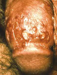 e14 A Online príloha Obrázek 7. Herpes genitalis penisu (podle 16) Obrázek 8. Condylomata accuminata (podle 17) Diagnóza: Odebírají se vzorky ze spodiny okrajů k mikroskopickému vyšetření.