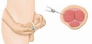 do topořivých těles nácvik aplikace testování optimální dávky riziko priapismu- prodloužené