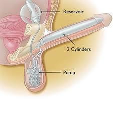 Možnosti řešení ED - mechanické pomůcky Vakuová zařízení ( pumpy )- navození erekce