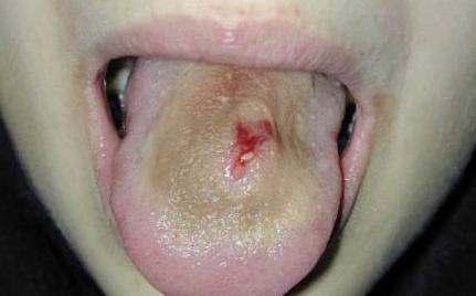Virové hepatitidy typu B, C a také D a G byly hlášeny a uznány jako komplikace piercingu jazyka.