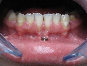 Klasifikace má 4 stupně: I. Gingivální recesus nepřesahuje mukogingivální hranici a nejsou žádné ztráty attachmentu nebo kosti interdentálně. II.
