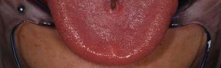 36 Piercing pod dolním rtem a v
