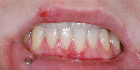 3.vyšetření Obr.39 Na horním rtu zaschlá krusta po herpes simplex labialis.