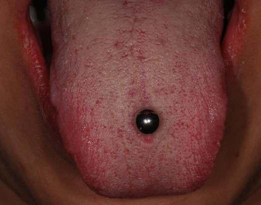 Obr.42 Piercing v jazyku,