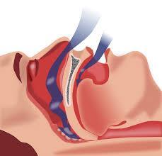 OSA increases morbidity and mortality Hypertension Stroke Heart failure