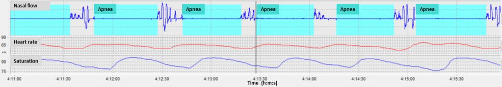 Obstructive Sleep Apnea Syndrome Intermittent hypoxia in tissues (fat,liver,