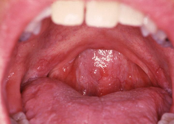 Pathogenesis of OSA Healthy OSA Anatomical