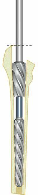 Popis implantátu Operační postup Instrumentárium Katalogová nabídka 2. Frézování lůžka pro proximální segment 2.1.