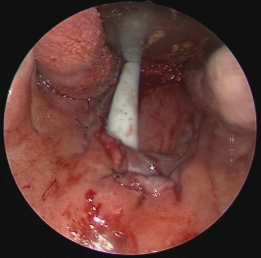 s adenotomií * UPPP (uvulopalatofaryngoplastika) - U lehkých až