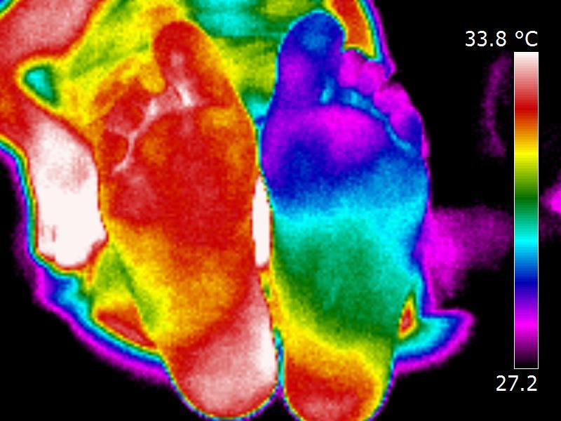 KAPITOLA 8. BEZKONTAKTNÍ TERMOGRAFICKÉ SYSTÉMY 188 Obrázek 8.11: Nedokonalé prokrvení z důvodů ischemické choroby dolních končetin. řečiště.