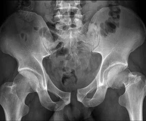 43/ Radiologické výsledky V souboru TIFI byla průměrná dislokace zadního segmentu 2,2 mm (0,0 11,6), v souboru IS činila průměrná dislokace zadního segmentu 1,9 mm (0,0 7,0; p = 0,58542).