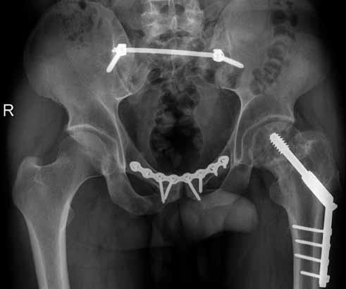 V oblasti pubických ramének kosti byl u TIFI průměrný posun 5,5 mm (0,0 20,8), u IS 4,6 mm (4,6 19,6; p = 0,43012).