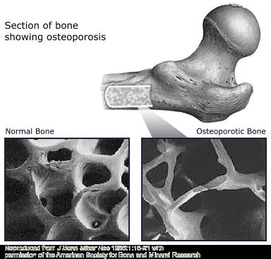 kostní hmoty a poruchami mikroarchitektury kostní