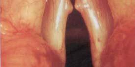 Při recidivách může být v místě původního hematomu nalezen polyp, který je nutné operativně odstranit [2]. 6.1.3 Hypereamia plicae vocalis Jde o překrvení hlasivek po extrémní hlasové námaze.