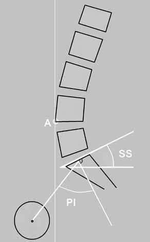 Biomechanika bederní páteře 3 Obr. 3.1 Parametry sagitální rovnováhy páteře: PI pelvic incidence, A vrchol (apex) bederní lordózy, SS sacral slope u starších osob.