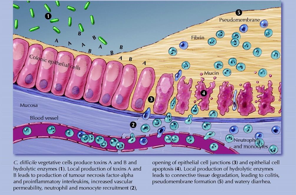 Clostridium difficile a jeho