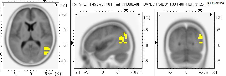 použití programu sloreta a) p ední cingulum b) gyrus angularis
