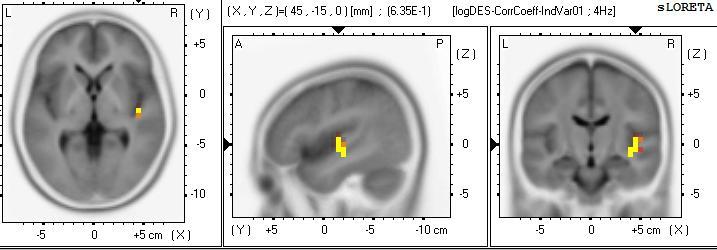 Obr. 9. Frekvence disociace pozitivn korelovala s proudovou hustotou celého pásma 2-40 Hz v inzulou vpravo a gyrus temporalis superior (r = 0,63; p < 0,05). Tab. 15.