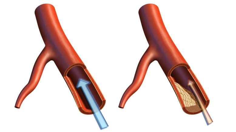 Hypertenzia Narušená bioelektrická