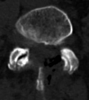 K akuizaci, s rozvojem neurologického deficitu se syndromem kaudy, dochází obyčejně v kombinaci s výhřezem meziobratlové ploténky. Bederní lumbální stenóza je onemocněním vyššího věku.