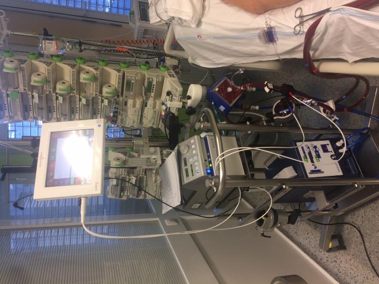 ECMO - indikace 7. RESCUE POSTUPY Respirační selhání neovlivnitelné konvenční ventilací PaO2/FiO2 pod 100 torr a FiO2 nad 0.