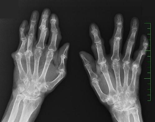 lokalizované okrajově v místech, kde jiţ kosti nejsou kryty chrupavkou, a tudíţ jsou dříve vystaveny invazi panu.
