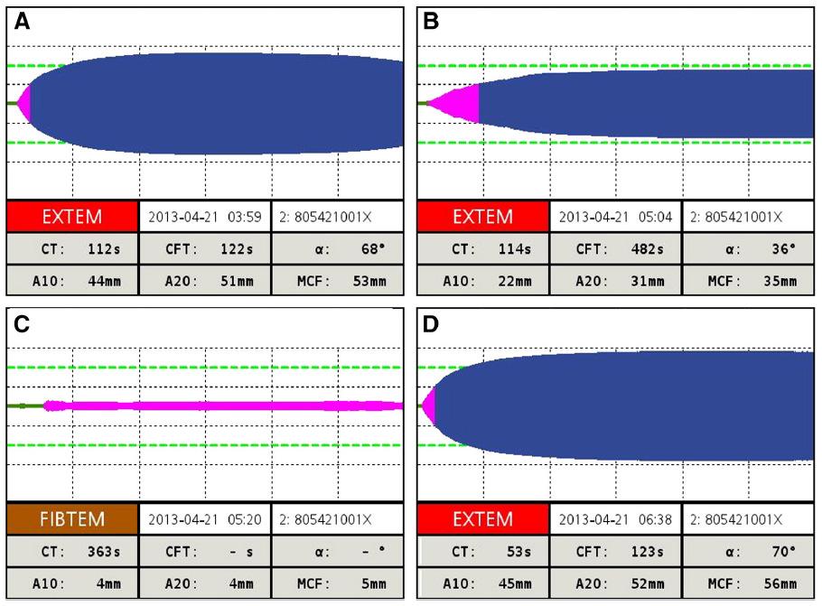 4.1. V naší první práci týkající se problematiky ŽOK s názvem Rotational thromboelastometry along with thromboelastography plays a critical role in the management of traumatic bleeding popisujeme