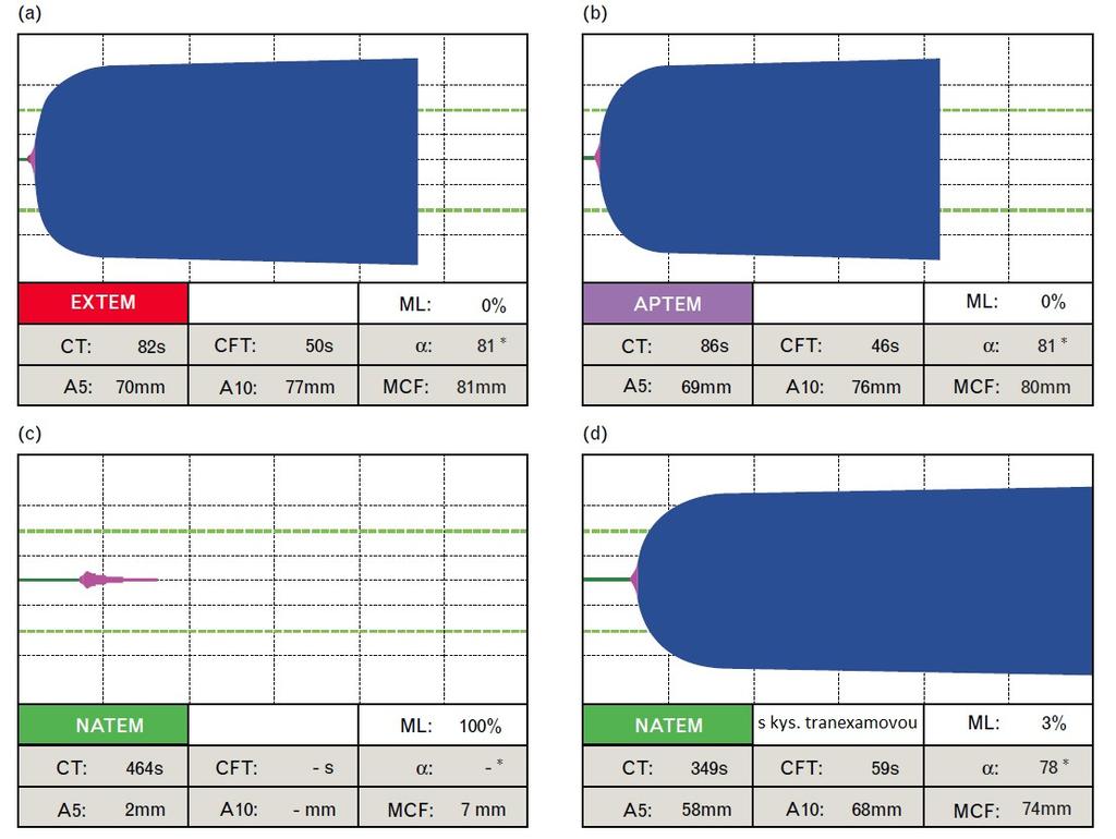 4.3. Nonactivated thromboelastometry able to detect fibrinolysis in contrast to activated methods (EXTEM/INTEM) in a bleeding patient Tato práce vyzdvihuje postavení nativní metody, tj.
