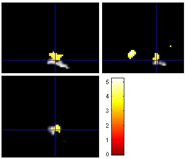 Tyto úseky byly podrobeny výše uvedenému experimentu. U dvou naměřených úseků nebyla zjištěna žádná korelace mezi regresorem a průběhem BOLD signálu (p < 0.001) a nebyly proto zařazeny do hodnocení.