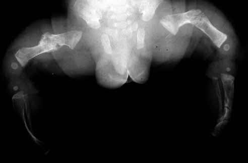 Obr. 7 Obr. 7. Vícečetné zlomeniny u osteogenesis imperfecta Fig. 7. Multiple fractures in osteogenesis imperfecta Obr. 8 Obr. 8. Subperiostální hematomy u skorbutu Fig. 8. Subperiostal hematomas in a scurvy case Obr.