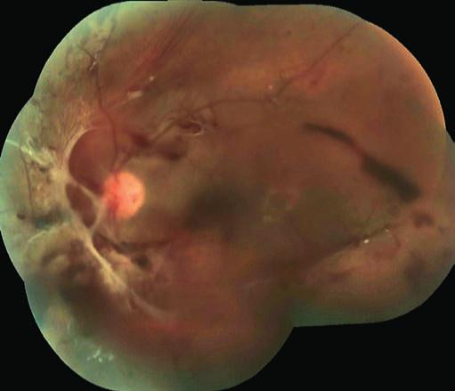 2: Vlevo krvácení do sklivce, těžká proliferativní forma diabetické retinopatie s trakčním odchlípením sítnice a rupturami v periferii Foto z archivu autora Foto z archivu autora Diskuse: Uvedená