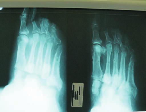 CHARCOTOVA OSTEOARTROPATIE Obr. č.