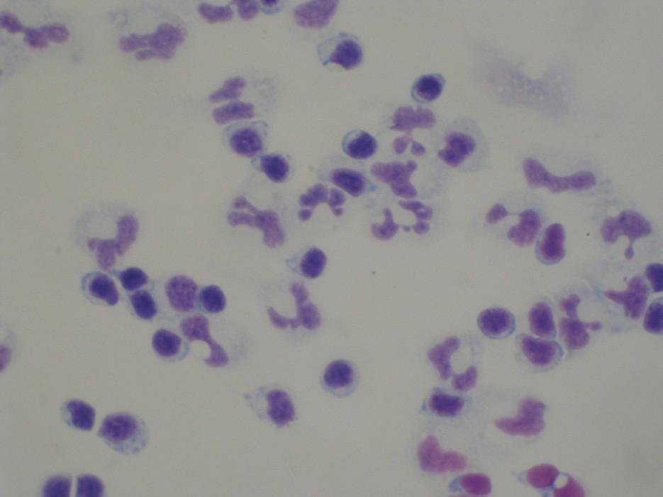 Typy cytologických likvorových nálezů Monocytární pleocytóza nebo