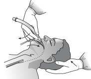 Obrázek 6 Obrázek 7 Metoda zavedení palcem: Tato technika je vhodná u pacientů s obtížným nebo nemožným přístupem k hlavě zezadu a při kardiopulmonální resuscitaci.