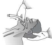 Jakmile se palec přiblíží k ústům pacienta, ostatní prsty natáhněte přes obličej pacienta (obr. 9). Palec maximálně natáhněte (obr. 10).