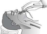 - Během anestezie nebo zákroku neposouvejte pacienta ani neměňte polohu laryngeální masky, aby nedošlo ke stimulaci dýchacích cest.