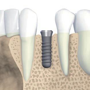 3.1.1 Mesiodistální pozice implantátu Dostatečný mesiodistální rozměr kosti je důležitým faktorem pro výběr typu implantátu a průměru, právě tak jako interimplantátové vzdálenosti tam, kde se jedná o