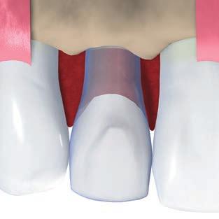 3.1.1.1 Příklady pro jednotlivé mezery Pro náhrady jenoho zubu se implantát umísťuje doprostřed mezery. Následující příklady ukazují, jak se aplikuje pravidlo č. 1.