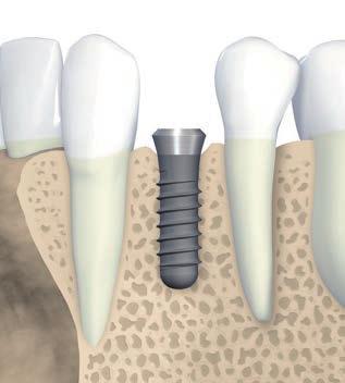 S/SP/TE Implantáty b a D 1.5 mm 1.5 mm Průměr krčku D (mm) Šířka mezery a min (mm) 3.5 (NNC) 5.5 6.5 4.8 (RN) 7 8 6.5 (WN) 8.5 9.