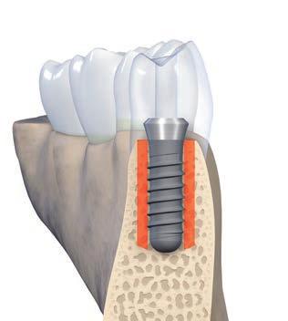 3.1.2 Orofaciální pozice implantátu Faciální a palatinální kostní lamela musí být nejméně 1 mm silná, aby byly zajištěny stabilní podmínky pro tvrdé a měkké tkáňě.