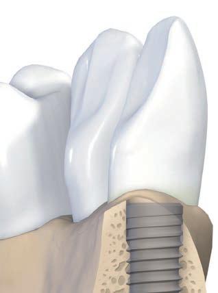 Straumann Bone Level implantáty Implantáty Straumann Bone Level jsou optimálně umístěny vnějším krčkem (zkosením) o 45 sklonu na úrovni kosti.