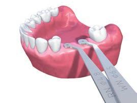 3.2.1.2 Indikátor vzdálenosti implantátů Straumann Jsou dostupné dva typy indikátorů vzdálenosti: Pro implantáty Straumann Standard, Standard Plus a Tapered Effect (Obj. č. 046.