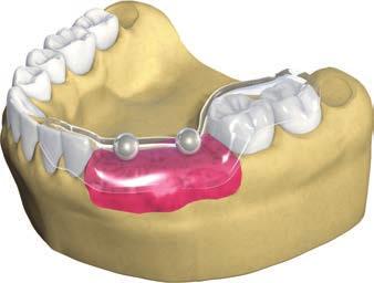 Indikátor vzdálenosti implantátů pro implantáty Straumann Bone Level Straumann Indikátor vzdálenosti pro implantáty Straumann Bone Level (Obj. č. 026.