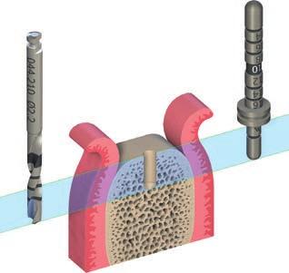 3 Krok 3 Naznačení osy implantátu Pomocí pilotního vrtáku 2.2 mm označte osu implantátu do hloubky 6 mm s výjimkou SPS implantátu, při kterém hloubka preparace nesmí přesáhnout 4 mm.