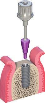 4.4.2 Transgingivální hojení Variabilní portfólio hojících kapen je dostupné pro všechny Straumann implantáty a umožňuje tvarování měkkých tkání během transgingiválního hojení.