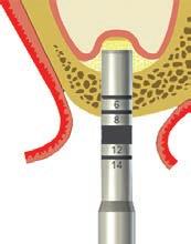 ѹ Kost se připraví pomocí spirálních vrtáků ( 2.2 mm/2.8 mm/3.5 mm/4.2 mm) v souladu s požadovaným průměrem implantátu.